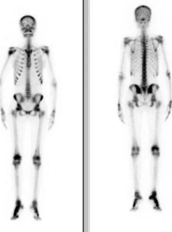 Figure  4 :  scintigraphie  osseuse  du  squelette  entier  en  face  antérieure  et  postérieure  montrant  une  hyperfixation  diffuse  symétrique  et  homogène  réalisant  un  aspect  de  trop  belle  image,  en  plus  des  hyperfixations du genou et du