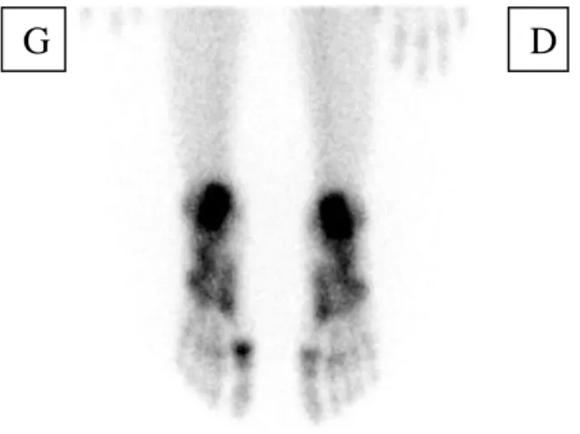 Figure  5 :  scintigraphie  osseuse  centrée  sur  les  parties  distales  des  membres  inferieurs  ne  montrant  pas  d’anomalies  de  captation  de  radiotraceur  si  ce  n’est  une  hyperfixation  de  la  première  articulation metatarsophalangienne ga