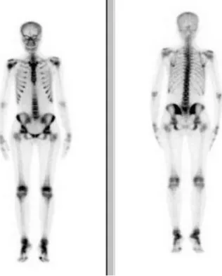 Figure 6: scintigraphie osseuse du squelette entier montrant une hyperfixation  diffuse  symétrique  et  homogène  réalisant  un  aspect  de  trop  belle  image