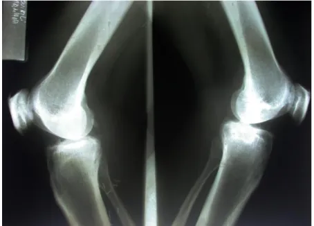 Figure  7 :  radiographies  standards  des  genoux  (profil  externe)  montrant  un  pincement  de  l’interligne  articulaire  avec  une  condensation  des  berges