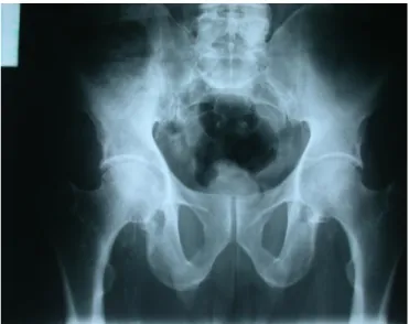 Figure 9 : radiographie standard des hanches sans anomalies. 