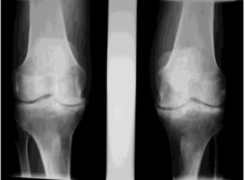 Figure 13 ; radiographie standard des genoux montrant des images géodiques  épiphysaires  bilatérales  avec  des  condensations  de  l’os  sous  chondral  mais  sans  pincement  des  interlignes  articulaires  ni  ostéophytose marginale