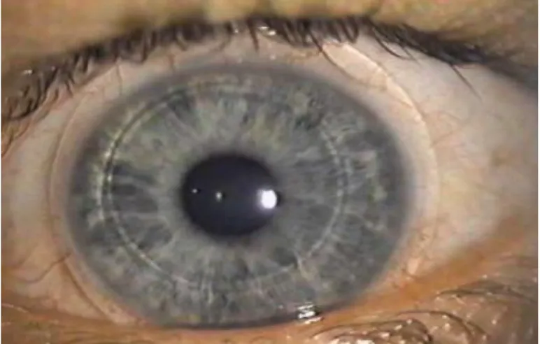 Figure 11 : Lentille hybride sur les yeux. 