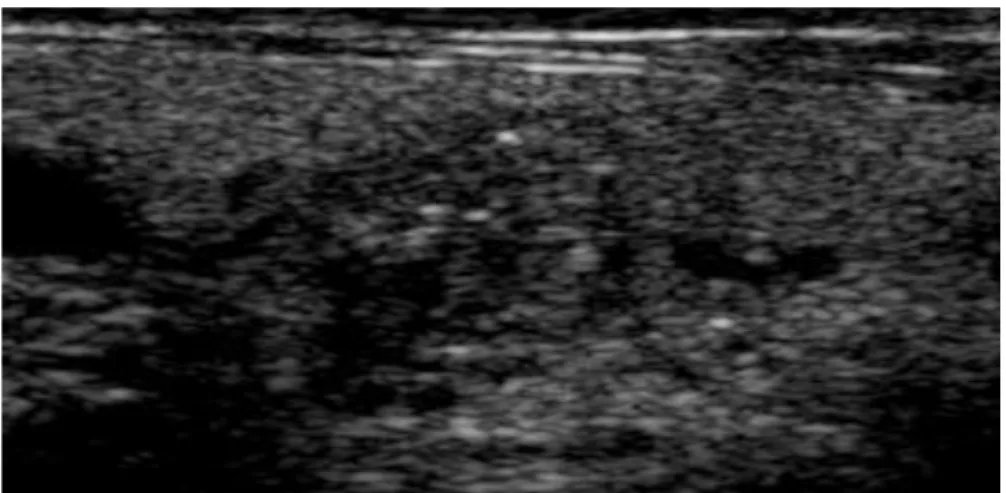 Figure 10 : Microcalcifications intranodulaires en mode B [41].  