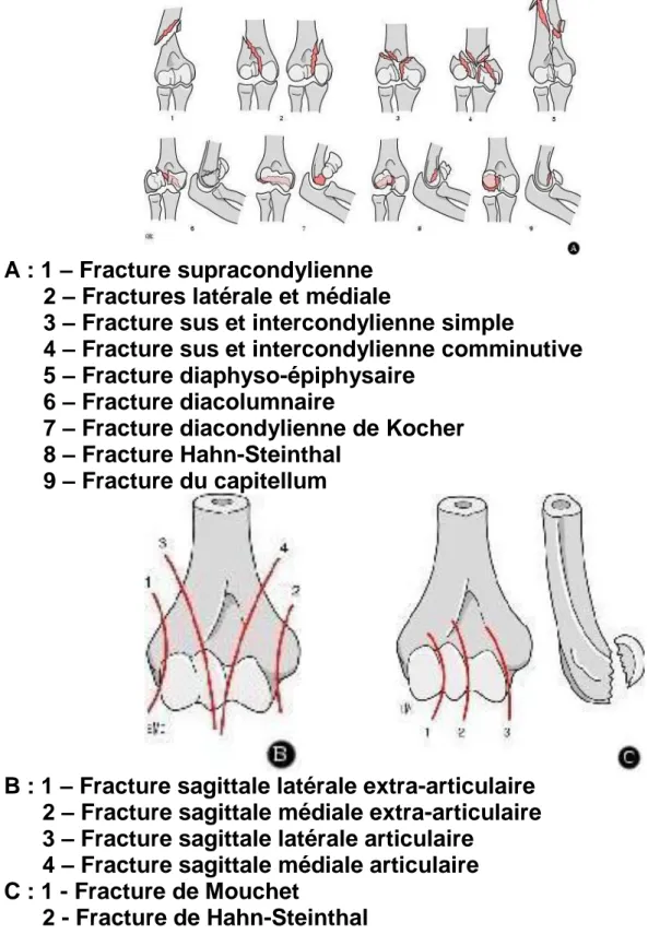 Fig 8 : Classification SOFCOT des fractures de la palette humérale. 