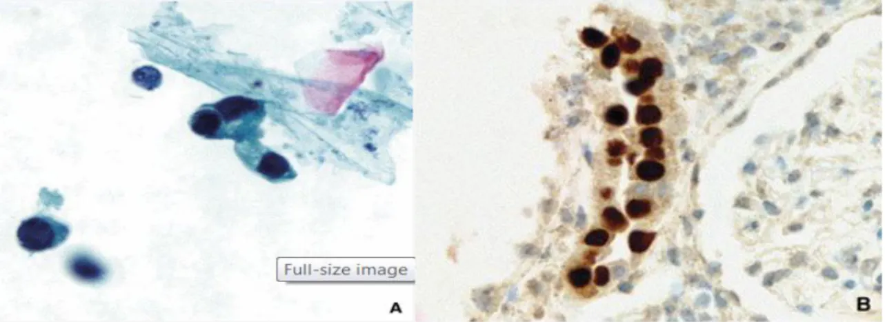 Figure 16 :  Néphropathie   BK virus : présence de  « decoy cells» dans les urines   inclusions virales intranucléaires, dans un tubule distal (immuno-marquage avec l'anticorps   SV40.Collins, MGH, Boston)