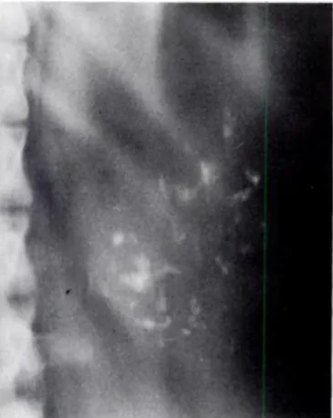 Fig. 18 : ASP vue de face  d’un néoplasme cystique séreux montre des calcifications  tumorales 