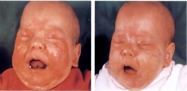 Fig .18 : Acrodermatite entéropathique 