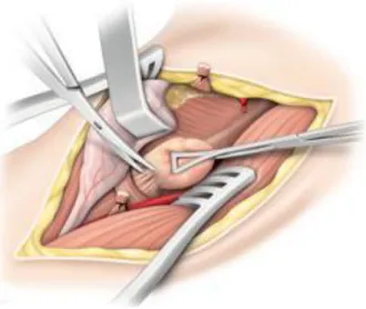 Figure 7 La face postérieure de l'œsophage a été décollée et le diverticule repéré droit devant  soi  ;  il  est  attiré  par  une  pince  de  Duval,  ce  qui  met  en  tension  ses  adhérences  œsophagiennes qui seront progressivement sectionnées