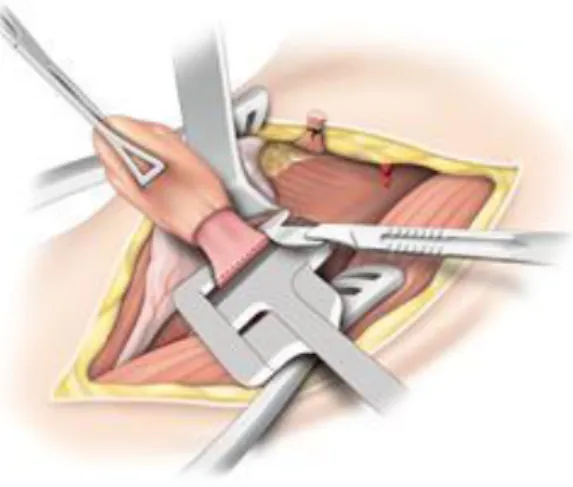Figure 9 : Agrafage mécanique. La pince à agrafage latéral est positionnée au niveau du collet,  le diverticule étant mis en légère traction