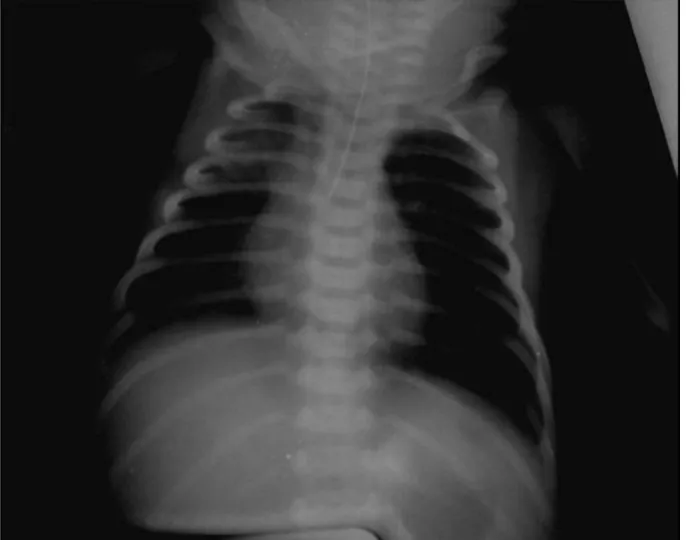 Figure 1 : Radiographie thoraco-abdominale montrant l’arrêt de la sonde gastrique au 1/3  moyen de l’oesophage