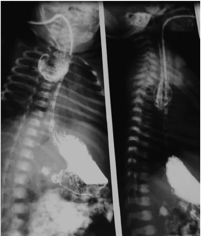 Figure 3. Opacification œsophagienne montrant une duplicité œsophagienne kystique située  au tiers supérieur de l’œsophage