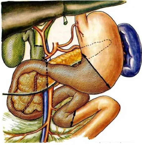 Figure 8 : Duodéno-pancréatectomie Céphalique (Exérèse). 