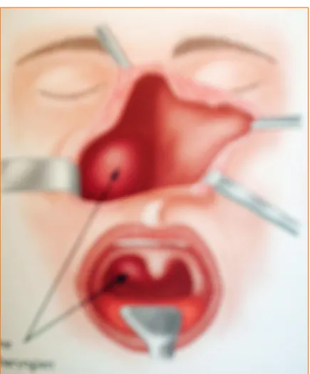 Figure n°9 : Voie paralatéronasale 