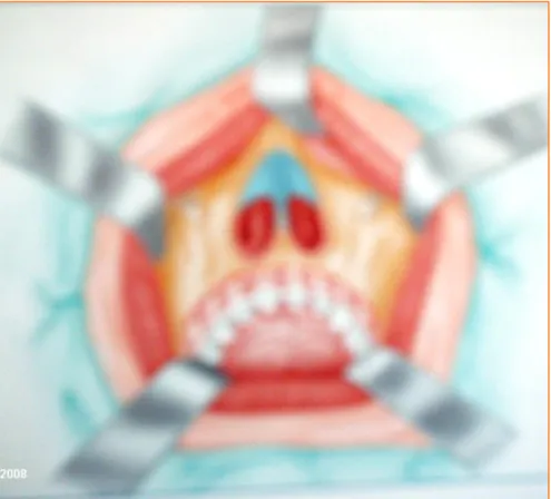 Figure n°13 : Vue antérieure du Dégloving 