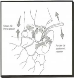 Figure 19 : Mécanisme combiné des fractures du radius distal.   