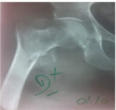 Figure 8: fracture pertrochantérienne complexe droite (avant chirurgie). 