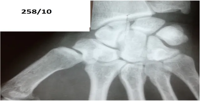Figure 6 : Radiographie du poignet, incidence de face,   montrant une fracture du scaphoïde type II de Schernberg