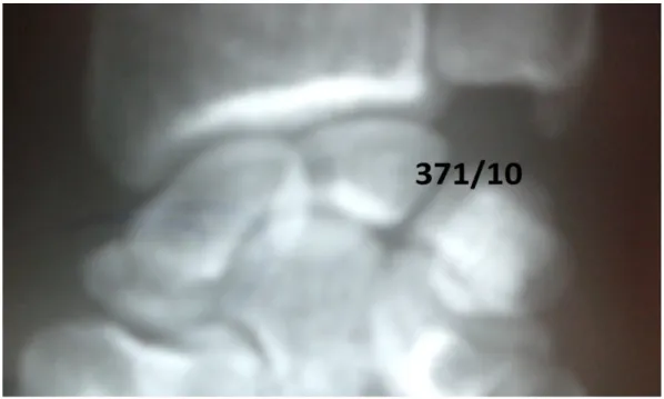 Figure 10 : Radiographie du poignet, incidence de face,   montrant une fracture du scaphoïde type VI de Schernberg