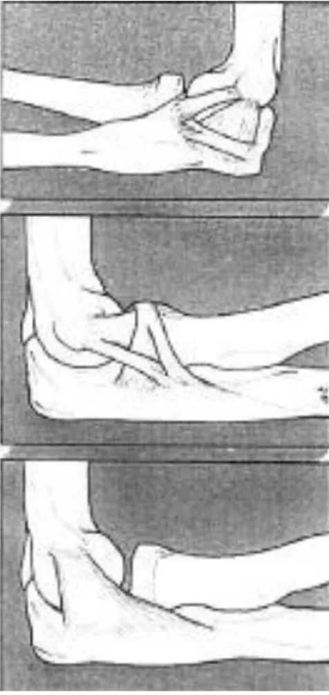 Figure 4.a: Représentation schématique du ligament latéral médial et de ses trois faisceaux