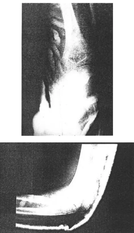 Fig 17 :Radio de face et de profil après réduction 
