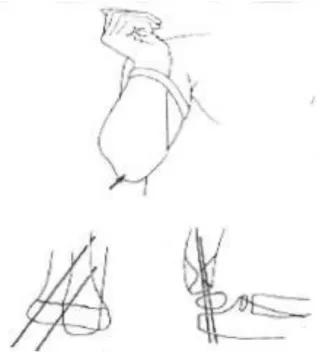 Figure n°.24: Méthode de Judet. Avant-bras fléchi sur le bras, maintenu par un garrot, point 
