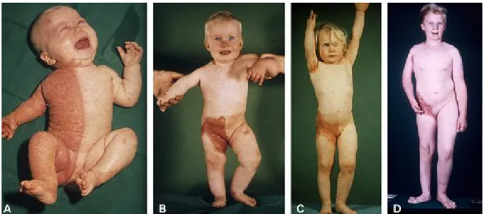 Figure 18 : l’évolution dans le temps de CHILD syndrome chez une fille a l’âge de 1 ,3et  11ans (68) 