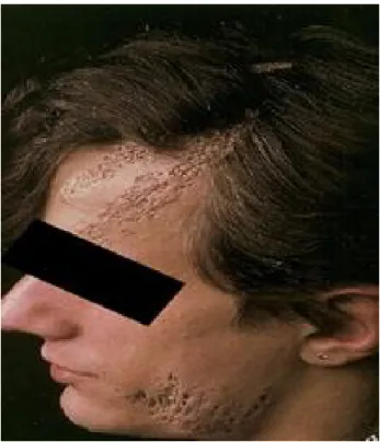 Figure 21 : syndrome de l’hamartome comédonien chez un adolescent : hamartome  comédonien systématisé unilatéral avec cataracte homolatérale et érosion cornéenne 