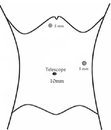 Fig. 31 : Emplacement des trocarts [60] 