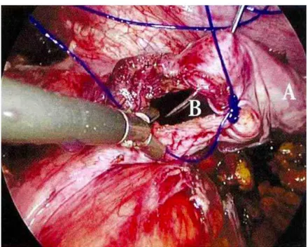Fig. 38: Fermeture du défect par des sutures sous laparoscopie [21]: 