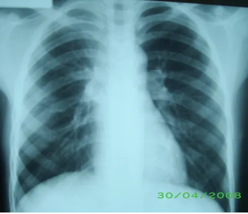 Figure n°7 : Radiographie pulmonaire de face de contrôle  ( 8 mois après cure chirurgicale) (cas n°2)