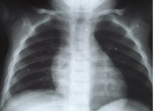 Figure n°12 : Radiographie pulmonaire de face de contrôle  (un mois après cure chirurgicale) (cas n°4)