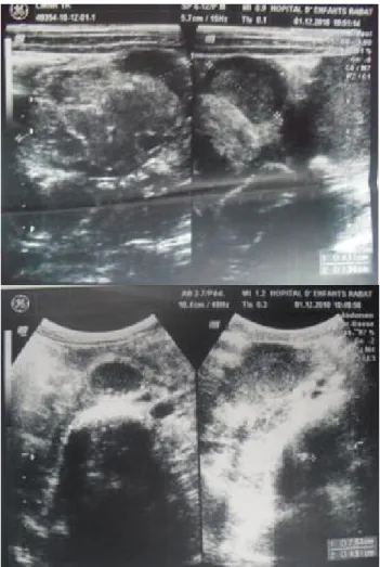Figure 1 : image d’échographie abdominale   de contrôle du 01/12/10  mis en évidence : 