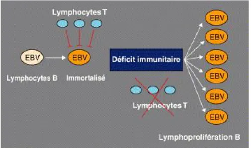 Figure 7 :Lymphoprolifération liée au virus d'Epstein-Barr (EBV) et déficit immunitaire