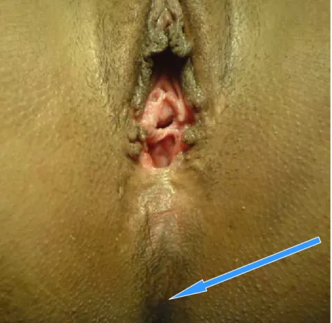 Figure 1b :   Flèche montrant le siège habituel de l’orifice anal. 
