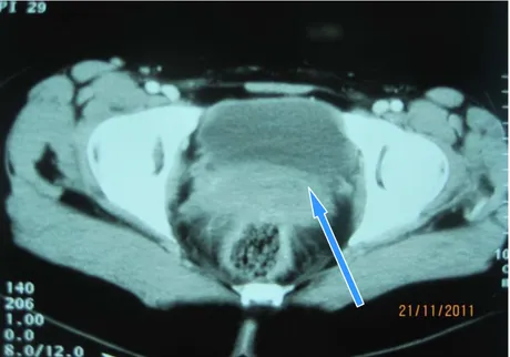 Figure 3 : Une TDM sans injection montrant un aspect double de l’utérus. 