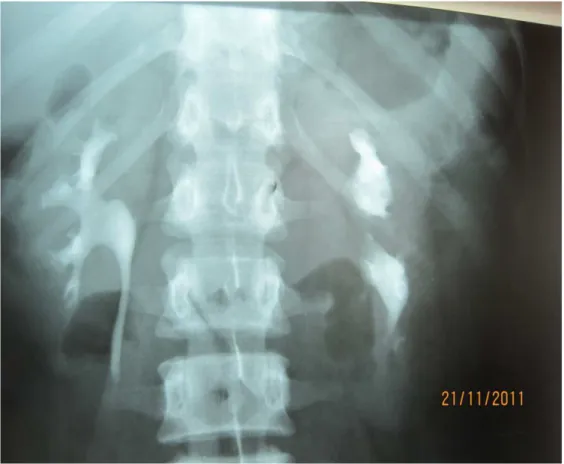 Figure 5 : Un rein gauche  dysroté avec dilatation modérée des cavités  excrétrices gauches 