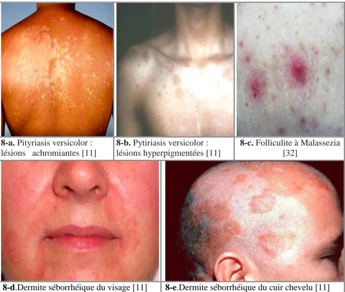 Figure 8 (a-b-c-d-e) : Aspects cliniques des dermatites à Malassezia. 
