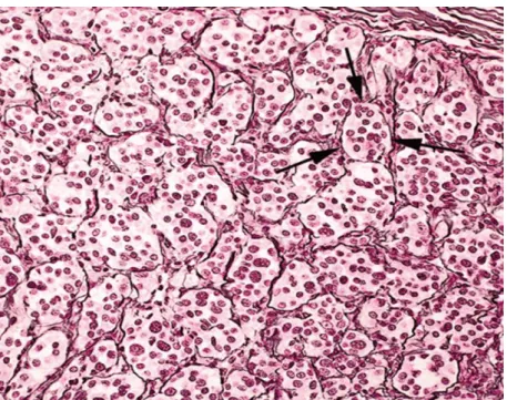 Figure  6:  Coupe  histologique  d'un  paragangliome  vagal  après  coloration  Hématine  éosine (HE) (Gx400): noter l'organisation alvéolaire (Zellballen) des cellules principales  entourées de fibres réticuliniques [5] 