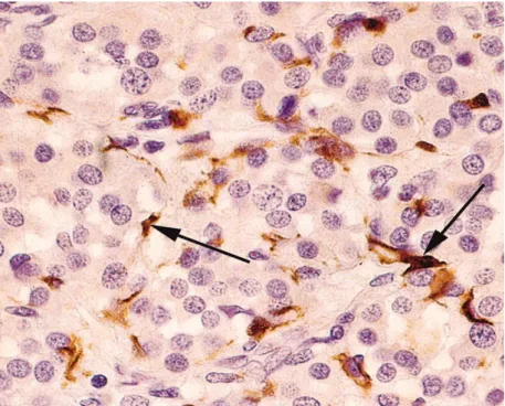 Figure 8: Coupe histologique d'un paragangliome vagal en immunohistochimie (Gx400). 