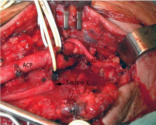 Figure 12: Vue opératoire après résection de la tumeur vagale chez la même patiente [29]