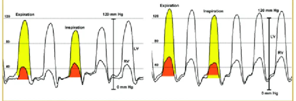 Fig.  19:  L’interdépendance  ventriculaire  et  la  variation  respiratoire  des  flux  de  remplissage ventriculaire dans la PCC (à gauche) et la CMR (à droite)