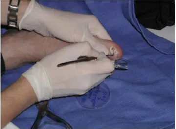Figure 1:  Réalisation du prélèvement d’ongle  [Photo du service de parasitologie, HMIM V].