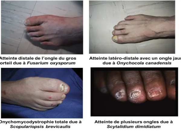 Figure 8 : Atteinte latéro-distale des ongles due aux pseudodermatophytes et moisissures   [Photo du service de parasitologie, HMIMV]