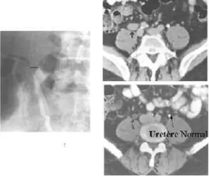 Figure 12 : Aspect en TDM d’une tumeur de l’uretère  [3] 