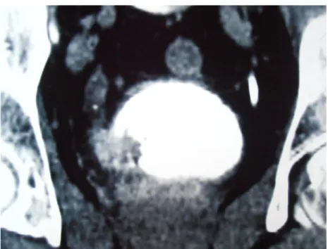 Figure 14 :Uroscanner : image lacunaire vésicale droite 
