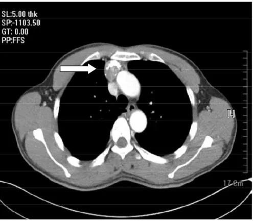 Figure 11 : TDM thoracique objectivant une masse du médiastin antérieur   calcifiée. [13] 