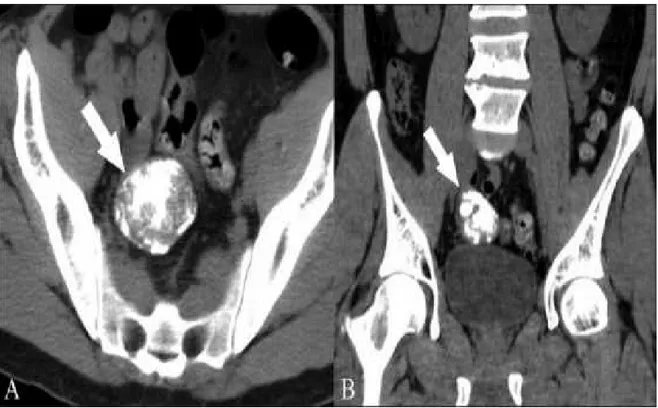 Figure  12 :  TDM  abdominopelvienne  sans  injection  de  produit  de  contraste  montrant une masse pelvienne (flèche) de 5 cm, densément calcifiés [41]