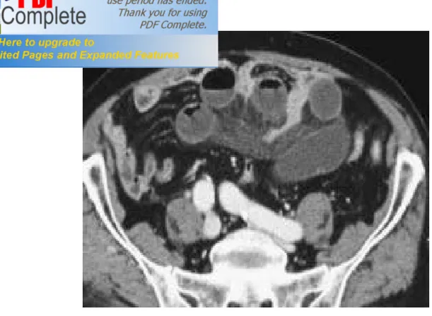 Figure 2 : Occlusion du grêle sur bride avec strangulation.Scanner abdominal avec  injection  de  produit  de  contraste  objectivant  le  retard  de  rehaussement  pariétal de l’anse souffrante (54)