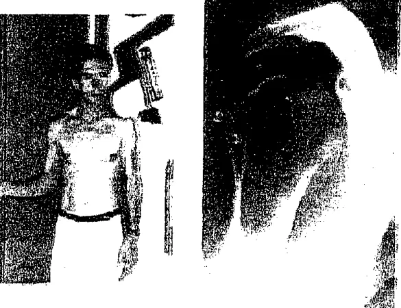 Figure 6 : Incidence de face en rotation externe 